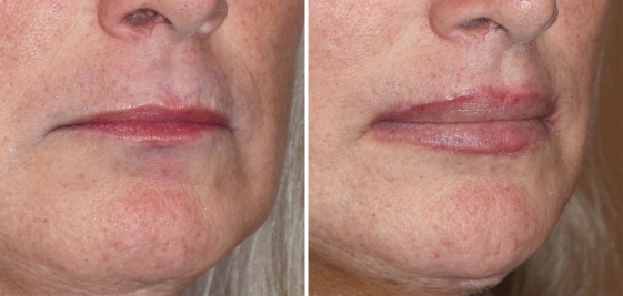 GE Lip Advancements result oblique view Dr Barry Eppley Indianapolis